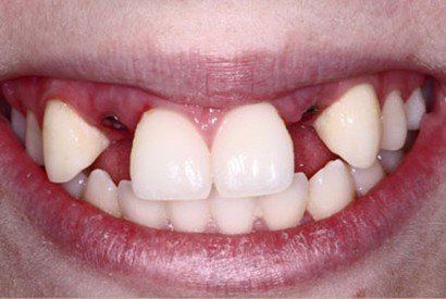Smile with missing top teeth with dental implant posts in place