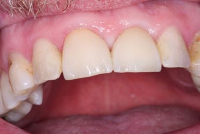 Whole healthy smile after tooth replacement