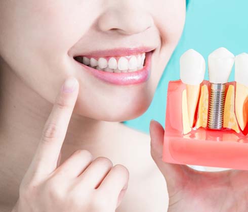 Cleburne implant dentist holding model implants and pointing to her smile