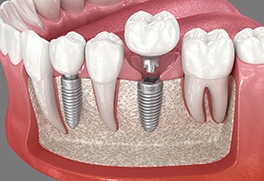computer illustration showing a dental implant within a jawbone
