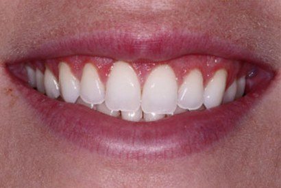 Flawless smile after gum reshaping