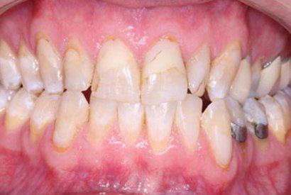 Severe dental decay and discoloration