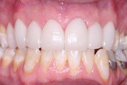 Healhty smile after complete dental restoration