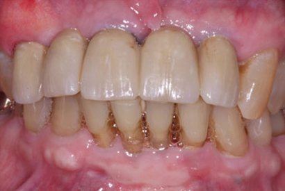 Healthy smile after tooth replacement and dental restoration