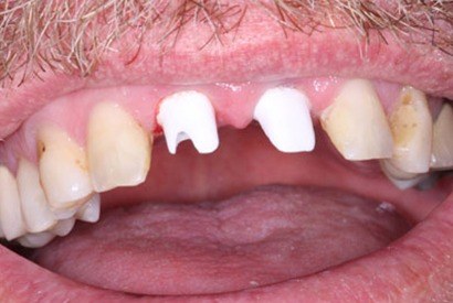 Missing top front teeth with dental implant posts in place