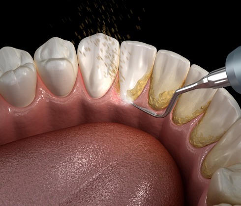 Digital image of tartar being removed from the bottom teeth