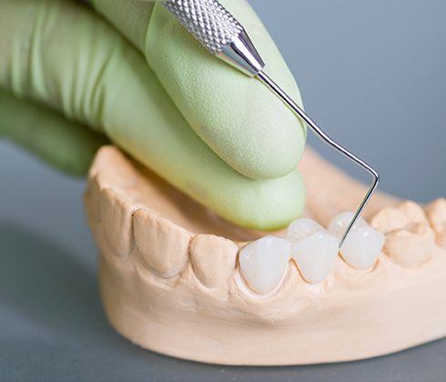 Model smile with dental crown supported fixed bridge