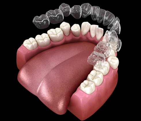 A digital image of an Invisalign aligner going on over a lower arch of crooked teeth in Cleburne