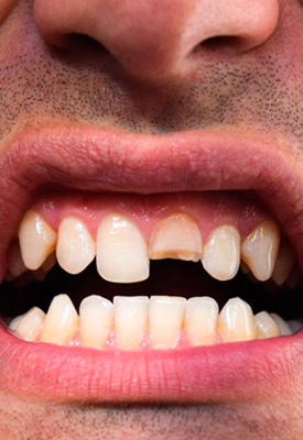 Close up of a patient’s broken tooth