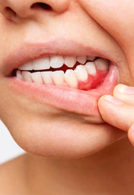 Woman pulling back lip to reveal bleeding gums