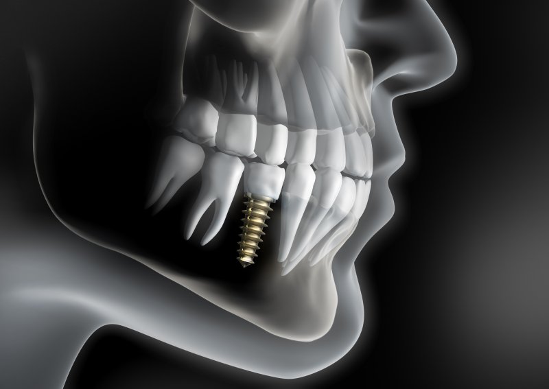 a digital image of a facial skeleton and a single tooth dental implant located in the lower arch of the mouth