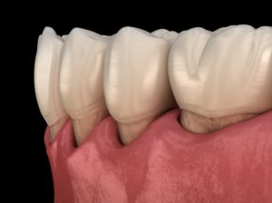 a digital image of a receding gum line occurring on the lower arch of the mouth