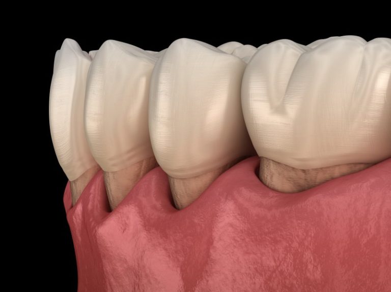 Dentist Gum Recession Reasons Long Family Dental