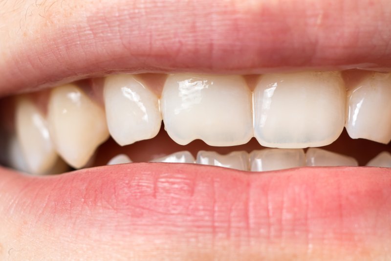 closeup of person with chipped tooth