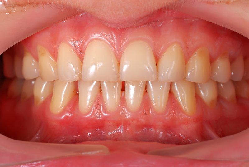 Your Dentist Says You Should Never Ignore Receding Gums!