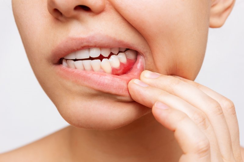 woman pointing to swollen gums 