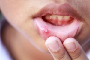 Canker sore on the lower lip