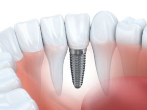 Dental implant in a lower jaw