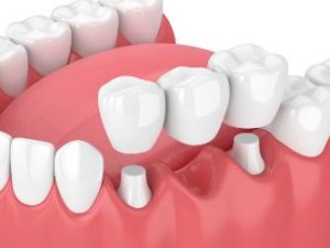 Model of a dental bridge being placed